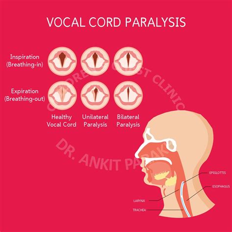 Vocal Cord Palsy in Neonates and babies: Causes, Diagnosis and ...