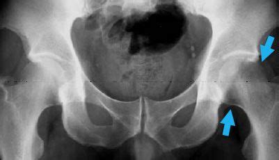 Transient Osteoporosis of the Hip - OrthoInfo - AAOS