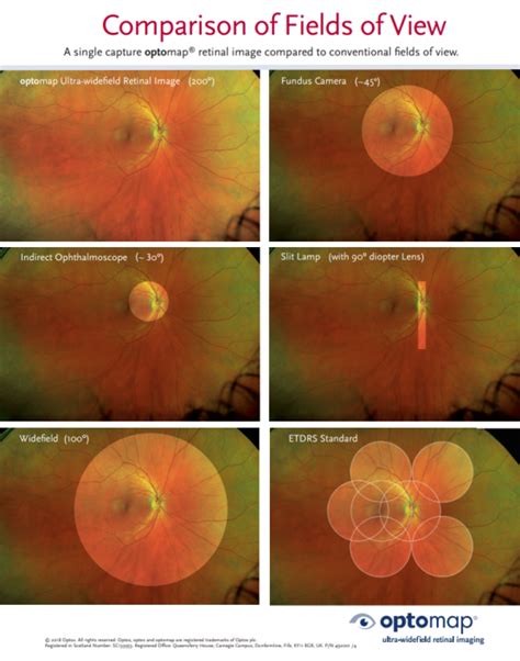 Optimal Retina Imaging | Eye Test Exam | Eye Care Orangeville