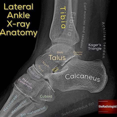 Foot X Ray Anatomy - Foot annotated x-ray | Image | Radiopaedia.org / Submitted on march 27 ...