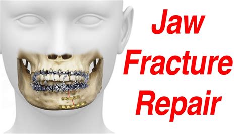 Jaw Fracture Surgical Treatment Animation (MMF - ORIF) - YouTube