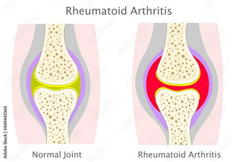 Rheumatoid Arthritis or RA disease diagram. Synovium, cartilage, bone loss anatomy. RA mainly ...