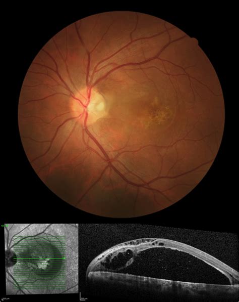 Optic Pit Maculopathy - Retina Image Bank