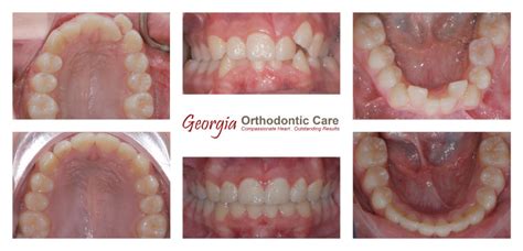 Crossbite Treatments