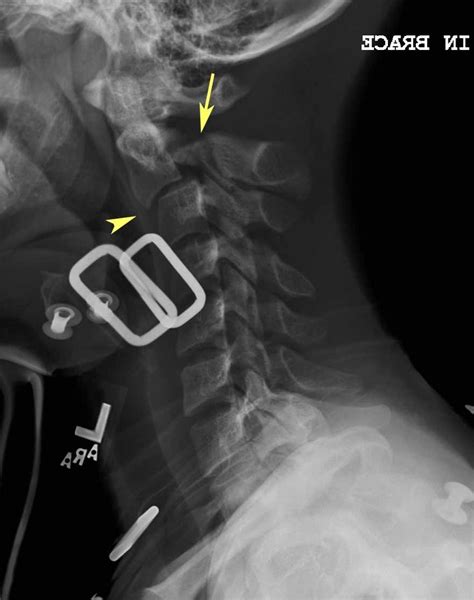 Hangman's Fracture (X-ray) - radRounds Radiology Network