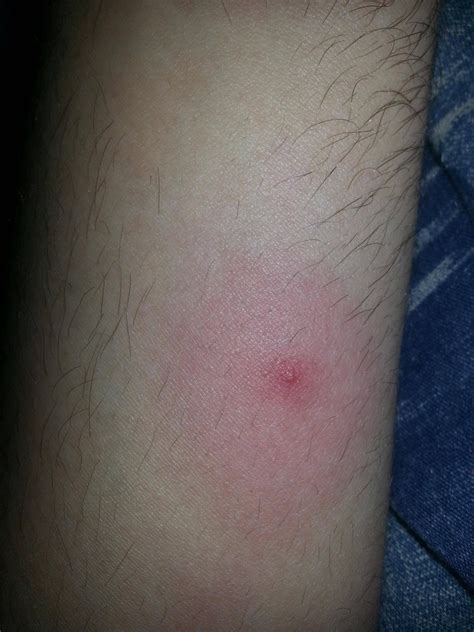 Lyme Disease Tick Bite Looks Like