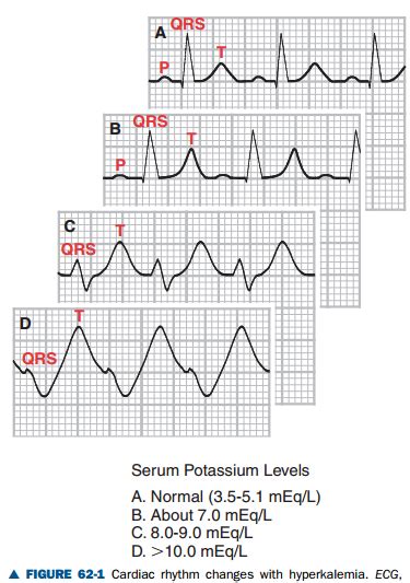 ECG changes with hyperkalemia: An elevated serum potassium level can cause tall, peaked T waves ...