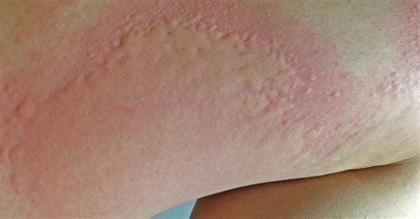 Is it a hepatitis C rash?