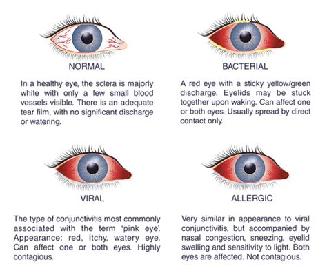 234 Images Of Viral Conjunctivitis Pics - MyWeb