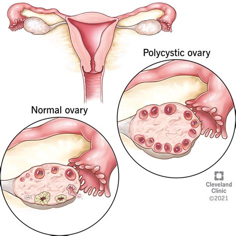 PCOS (Polycystic Ovary Syndrome): Symptoms & Treatment | Flipboard