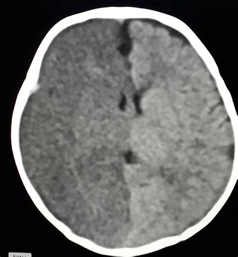 Rasmussen Encephalitis - CT may not show any specific feature in early ...