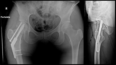 Femoral Neck ORIF