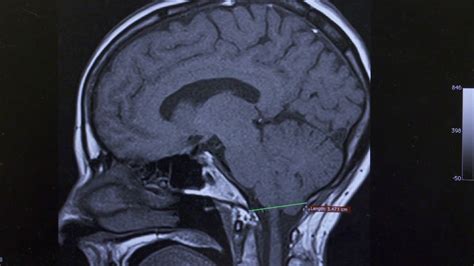 Understanding Chiari Malformation Types Symptoms And - vrogue.co