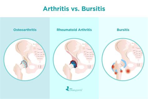 What’s the Difference Between Arthritis and Bursitis?