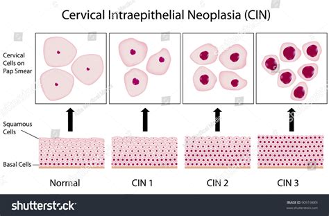 Cervical Dysplasia Stages Cervix Cell Morphology Stockillustration 90919889 | Shutterstock