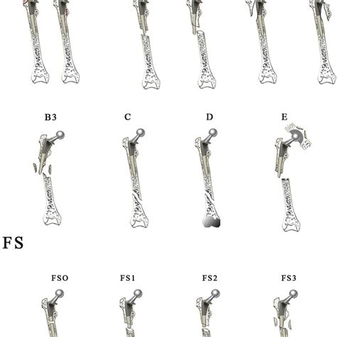 Current periprosthetic femoral fracture classifications. | Download Table