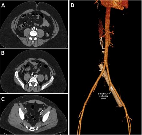 Intravascular Ultrasound in Treating Iliac Vein Compression With Endovascular Stenting: A ...