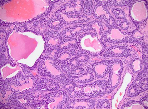 Thyroid Adenoma Histology