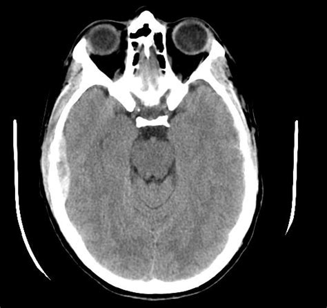 ON - RADIOLOGY: Epidural hematoma in CT