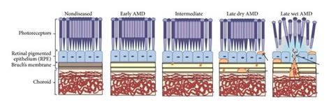 Stages of AMD: early AMD, intermediate AMD, late dry AMD, and late wet ...