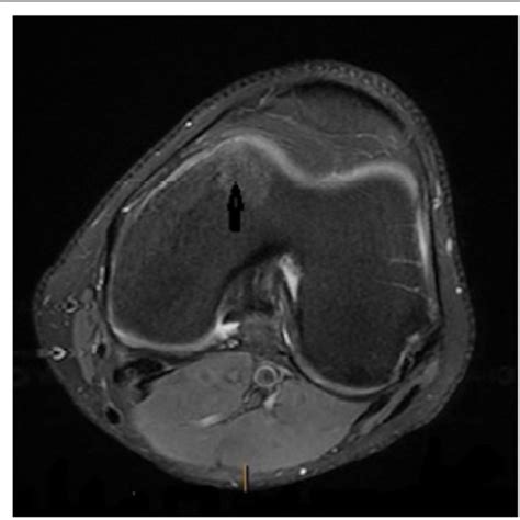 Left Knee T1 MRI showing subtle abnormality of subchondral bone in the... | Download Scientific ...