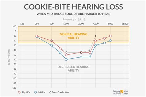 Cookie Bite Hearing Loss: Causes, Symptoms, and Treatment