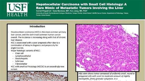 Hepatocellular Carcinoma with Small Cell Histology: A Rare Mimic of Metastatic Tumors Involving ...