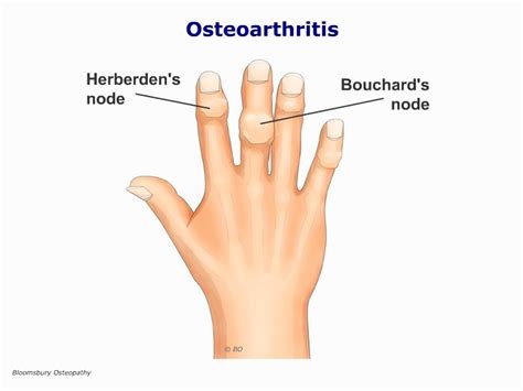 Osteoarthritis of the Fingers HANP03 - Bloomsbury Health Centre