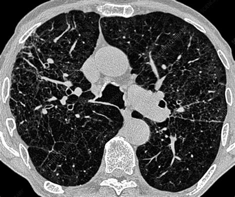 Emphysema Causes, Symptoms, Diagnosis, Treatment