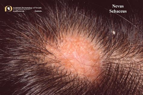 Nevus Sebaceus: Of Jadassohn... - Academic Dermatology of Nevada