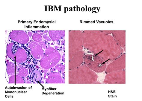 Muscle Biopsy - Cure IBM