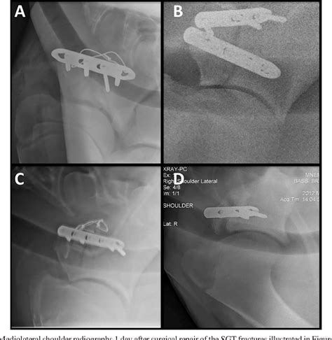 Figure 2 from Supraglenoid tubercle fractures repair with transverse locking compression plates ...