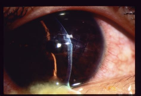 Corneal Laceration / Repeat Trauma - Retina Image Bank