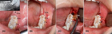 Frontiers | Alveolar ridge preservation in post-extraction sockets using concentrated growth ...