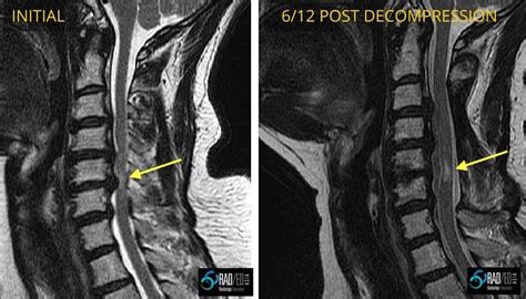 Spondylotic Myelopathy vs Myelomalacia: No more confusion - Radedasia