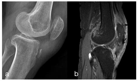 Medicina | Free Full-Text | Isolated Avulsion Fracture of the Tibial ...