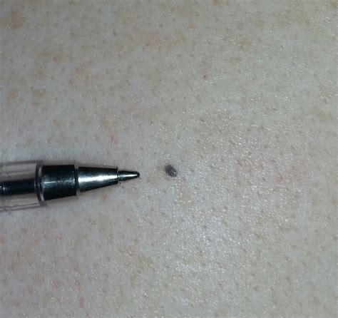 small black spot found on upper back | Cancer | Forums | Patient