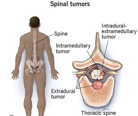 Symptoms of Spinal tumor - MEDizzy