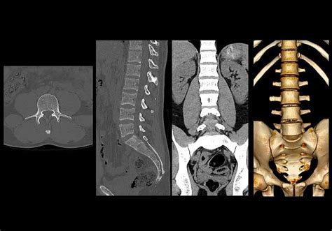 Rachis lombaire TDM : anatomie normale | e-Anatomy