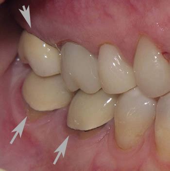 Pfm Crowns Vs Zirconia - dream-inuyasha