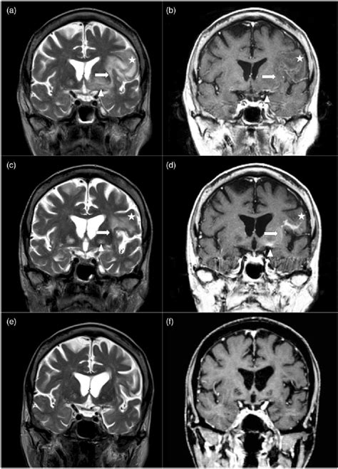 Serial brain MRI coronal T2 and post-gadolinium-enhanced T1 images at ...