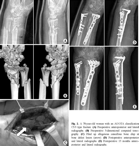 Figure 2 from Treatment of the Communited Distal Radius Fracture Using Volar Locking Plate ...