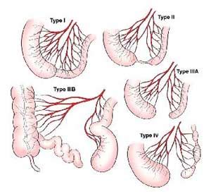 Intestinal Atresia & Stenosis | Types, Diagnosis & Treatment