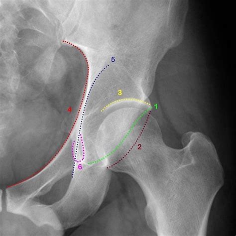 Radiographic anatomy of the acetabulum by Dr Benoudina Sam… | Flickr