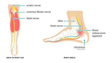 Tarsal Tunnel Syndrome: Symptoms, Causes, and Treatments