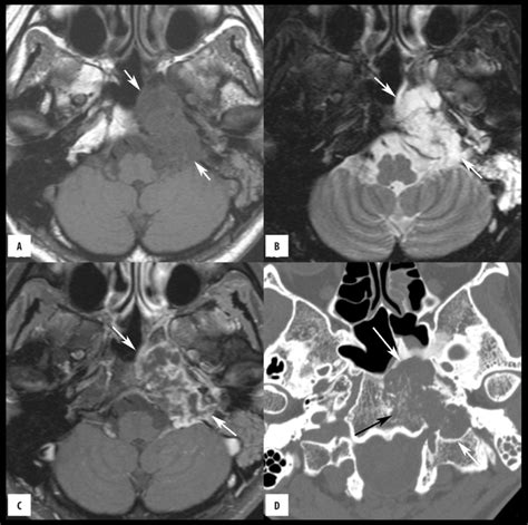 Skull base chondrosarcoma in a 46-year-old woman. (A) Axial ...