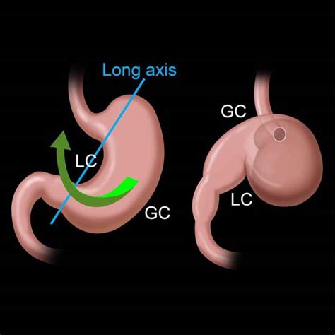 Gastric Volvulus | Radiology Key