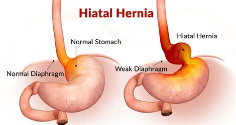 Hiatal Hernia - Causes, Symptoms and Treatments