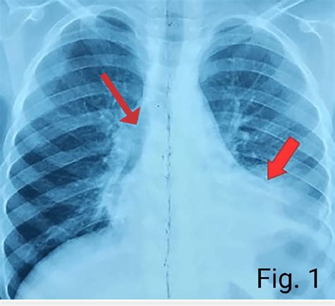 Air Bronchogram Chest X Ray