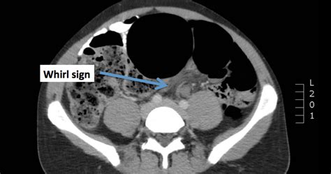 Emergency Medicine Visual Diagnosis: Diagnosis: Sigmoid Volvulus